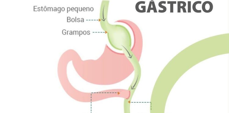 BYPASS GÃTRICO