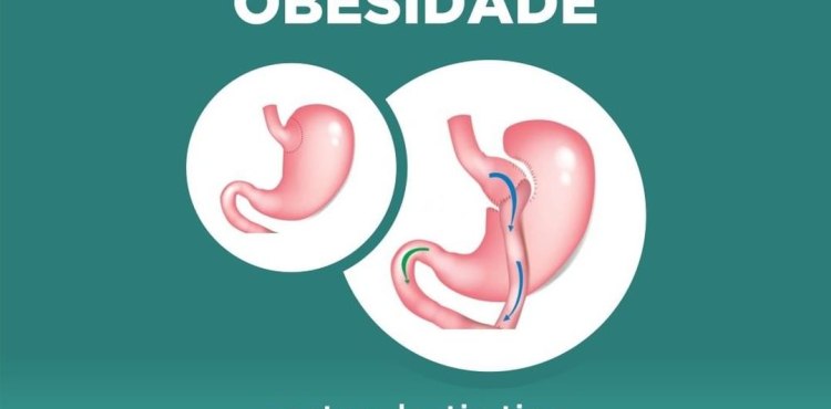 Bypass em Y de Roux - Procedimento