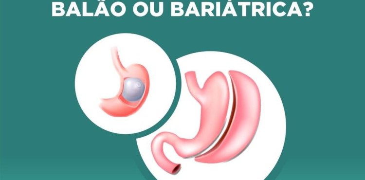 Obesidade: Balão ou Bariátrica