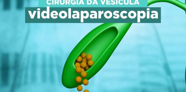 Cirurgia da vesí­cula por videolaparoscopia,