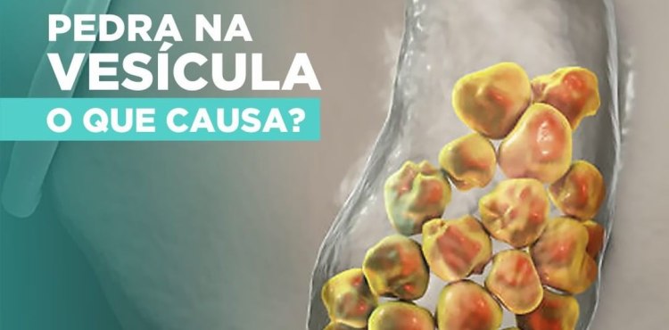 O que causa pedra na vesí­cula?