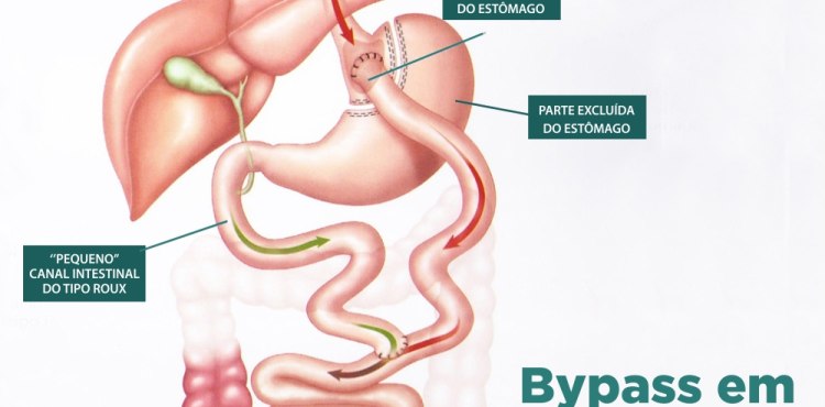 Resultados  - Bypass em Y de Roux