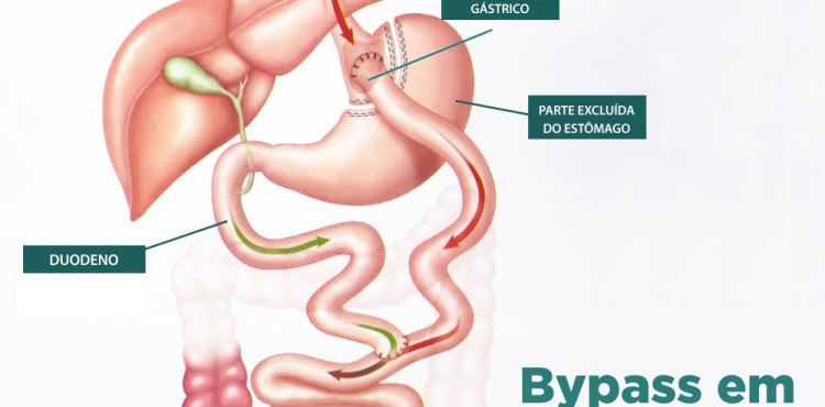 Bypass em Y de Roux - Resultados