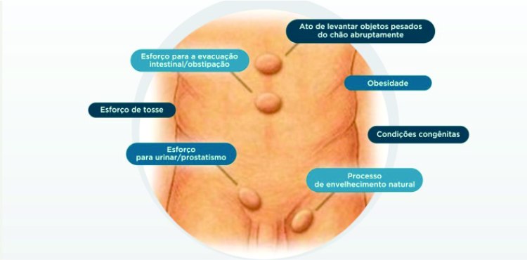 Atividades que podem contribuir para o surgimento de Hérnias Abdominais