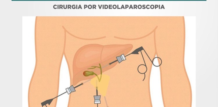 Tratamento CÃ¡lculo de VesÃ­cula Biliar - Cirurgia por Videolaparoscopia
