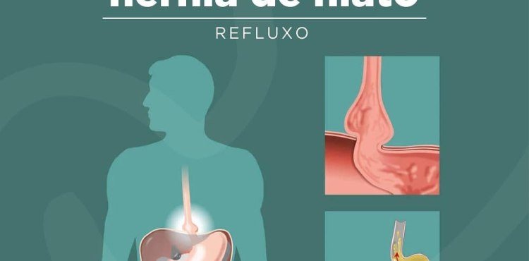 HÃ©rnia de Hiato | Refluxo