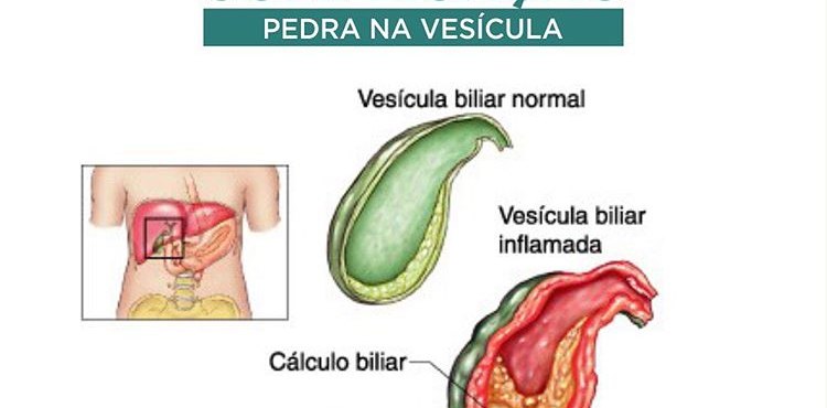 Pedra na VesÃ­cula