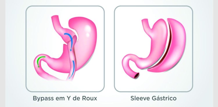 Conheça as técnicas de Cirurgia Bariátrica e Metabólica