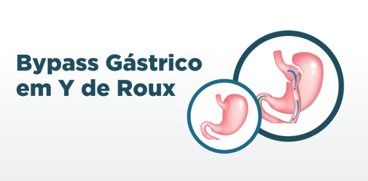 Bypass em Y de Roux