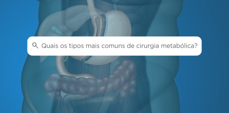 Quais os tipos mais comuns de cirurgia metabólica?
