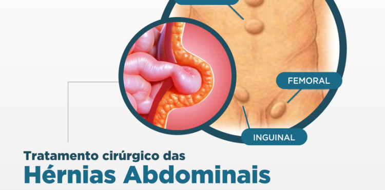 Tratamento Cirúrgico das Hérnias Abdominais - Cirurgia Robótica
