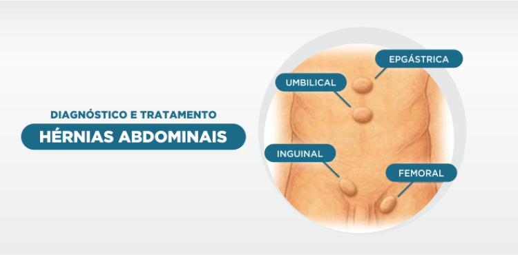 Diagnóstico e Tratamento para Hérnias Abdominais
