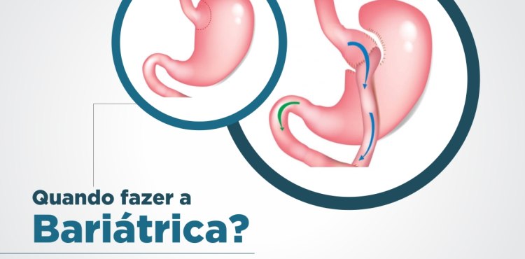 Quando fazer Bariátrica?