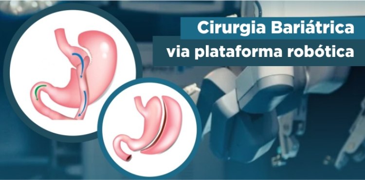 Cirurgia Bariátrica via plataforma robótica