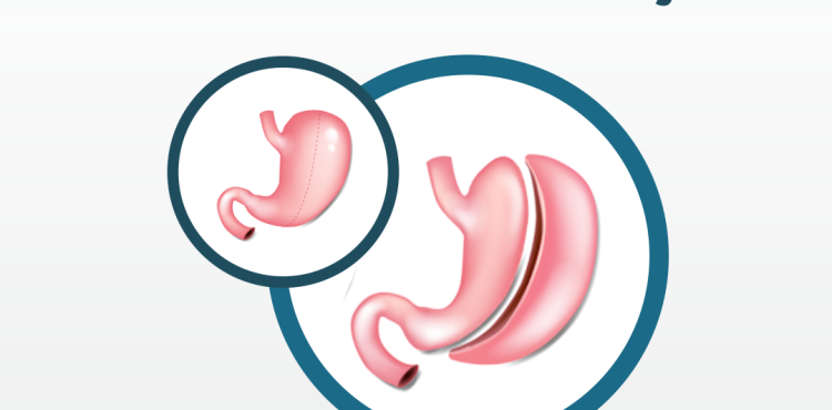 Gastrectomia vertical ou Sleeve Gastrectomy - O que é?