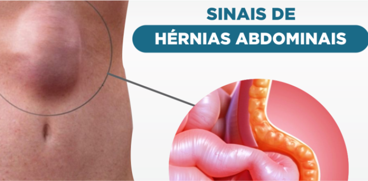 Sinais de Hérnias Abdominais