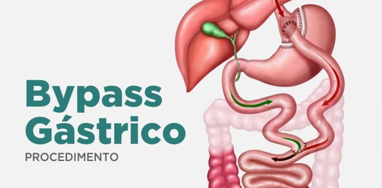 Bypass GÃ¡strico