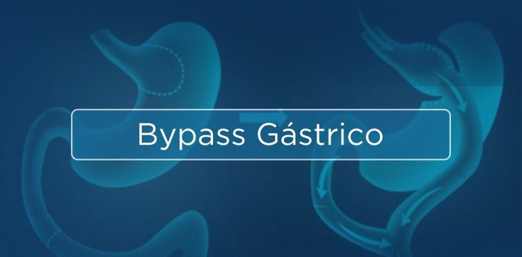 Bypass GÃ¡strico