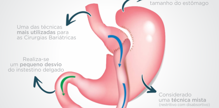 Conheça a técnica Bypass em Y de Roux