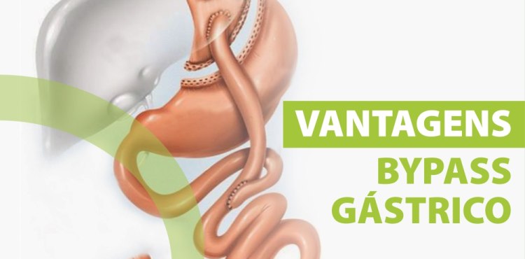 Vantagens Bypass em Y de Roux