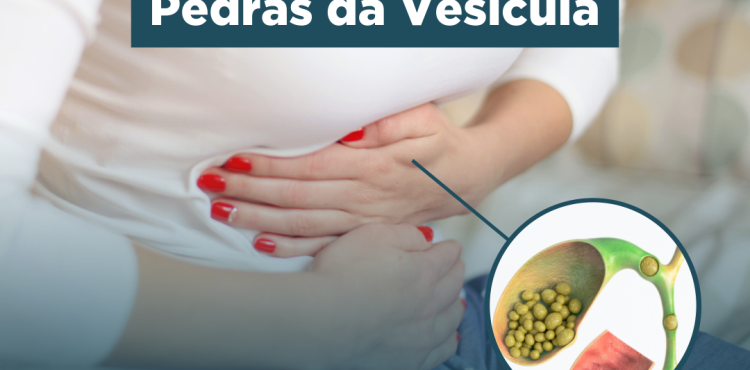 Cálculos Biliares | Pedras na Vesícula