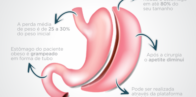 Conheça mais sobre a técinica Sleeve Gástrico