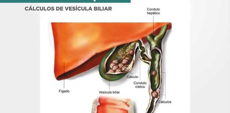 ComplicaÃ§Ãµes CÃ¡lculos de VesÃ­cula Biliar