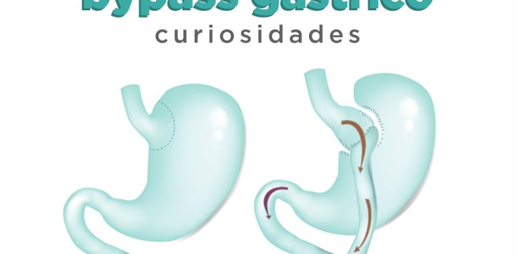 Bypass GÃ¡strico - Curiosidades