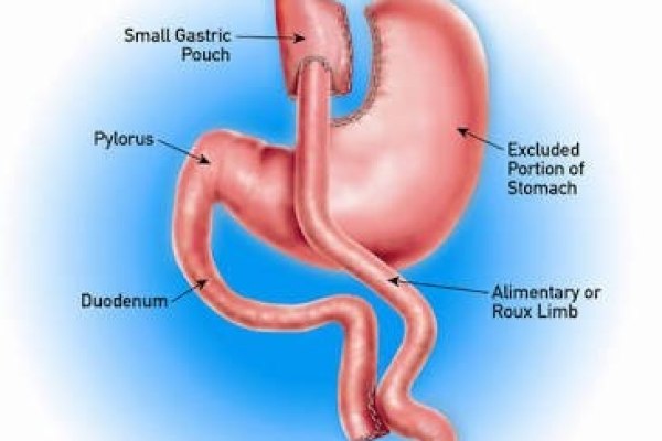 https://www.drmarlonrangel.com.br/portfolio/bypass-gastrico-em-y-de-roux/9/